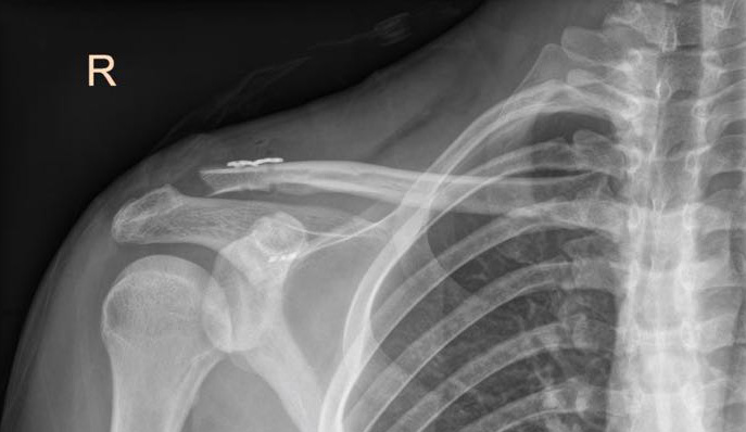 AC joint reconstruction | shoulder surgeon Perth