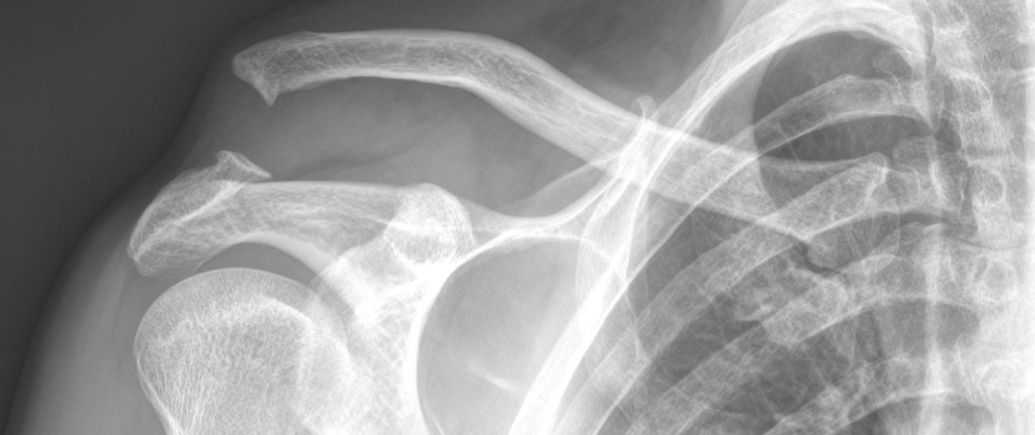 AC joint dislocation | shoulder surgeon Perth