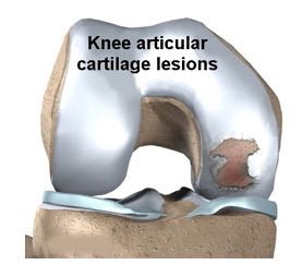 Knee cartilage