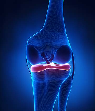 meniscus tear | knee surgeon Perth
