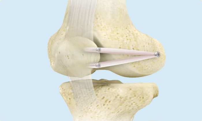 MPFL reconstruction | knee surgeon Perth